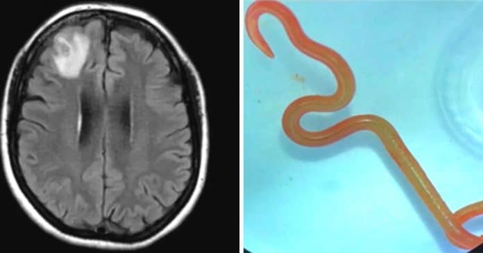 Verme parasita vivo foi encontrado no cérebro de uma mulher pela primeira vez no mundo