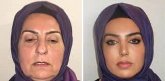 Fotos de antes e depois de cirurgia plástica na Turquia surpreendem a internet