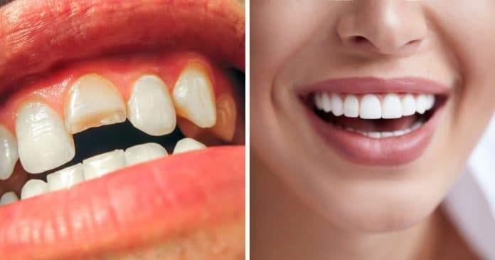 EVOLUÇÃO: Primeiro medicamento mundo para “crescer” dentes perdidos é aprovado para testes em humanos