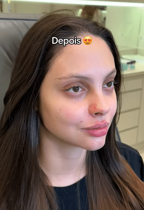 sabiaspalavras.com - VÍDEO: Jovem faz harmonização facial para ficar parecida com Angelina Jolie e resultado impressiona